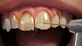 Porcelain Veneers